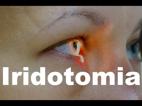 Iridotomy