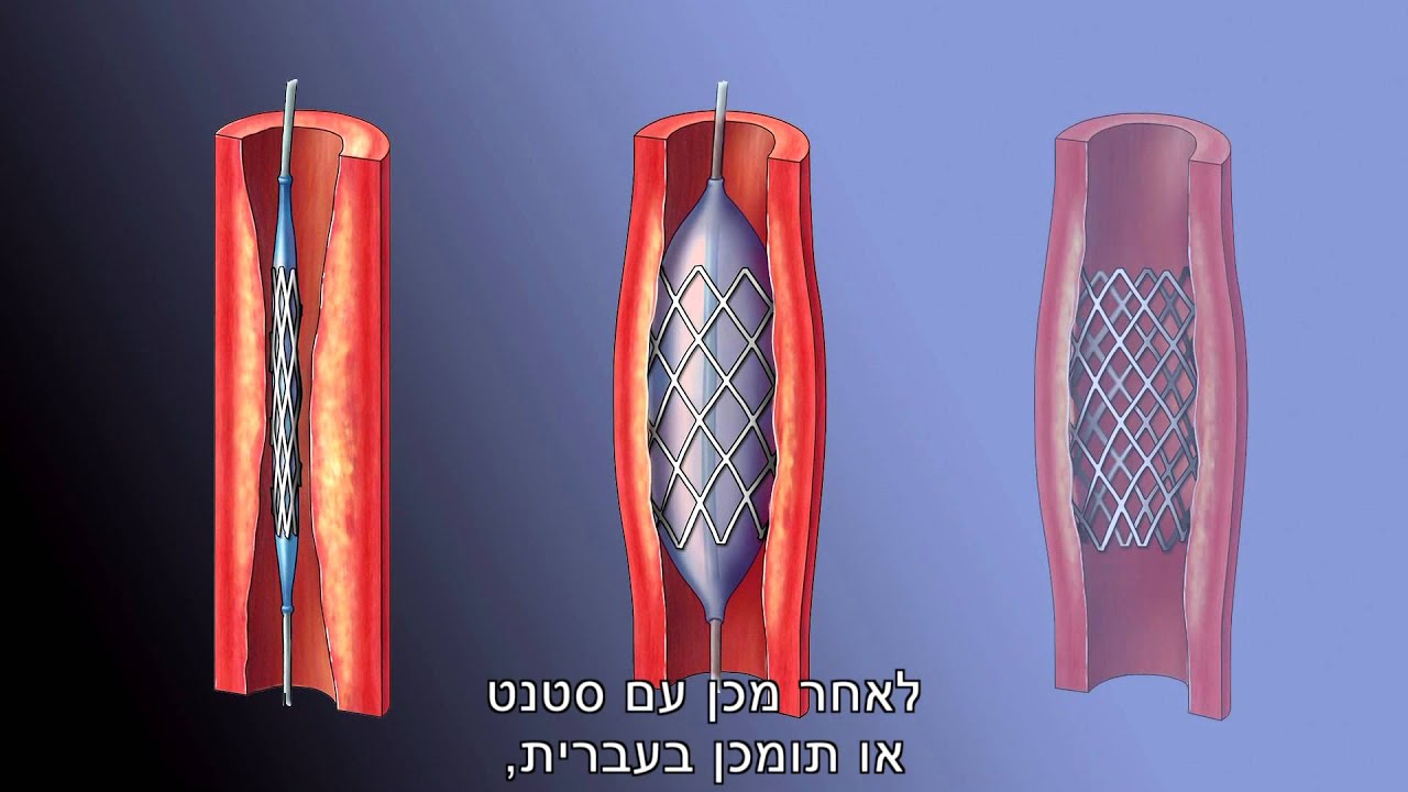 צנתור לב כלילי - סרטון הדרכה למטופל