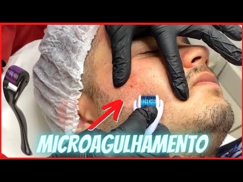 Microagulhamento - Poros Abertos (Primeira Sessão)