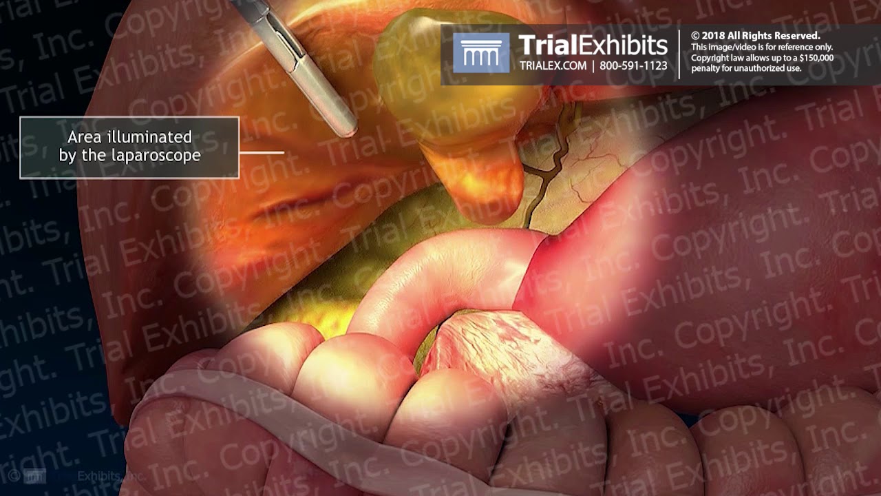 Laparoscopic Lumen-guided cholecystectomy in face of the difficult  gallbladder | Surgical Endoscopy