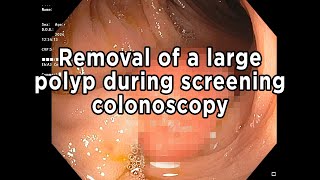 Removal of a large polyp found during a screening colonoscopy. THESE HAVE NO SYMPTOMS!