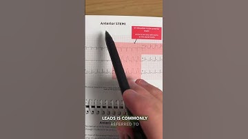 How to spot a STEMI #short