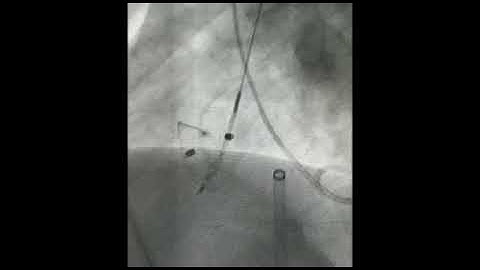 Three Occluders Closing Large Perimembranous Vsd with PDA