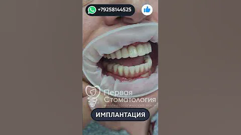 Имплантация зубов пациенту. До и После.