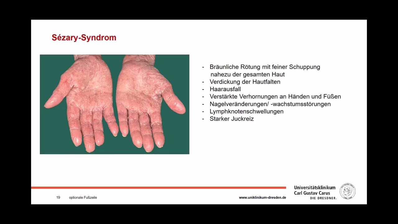 Das T-Zell-Lymphom der Haut: Selten und oft spät erkannt. Dr. Marlene