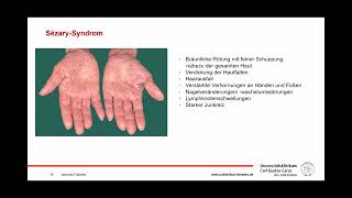 Das TZellLymphom der Haut: Selten und oft spät erkannt. Dr. Marlene Garzarolli (NCT/UCC)