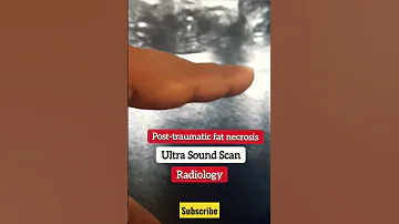 Post traumati fat necrosis -  Ultra Sound Scan & Radiology