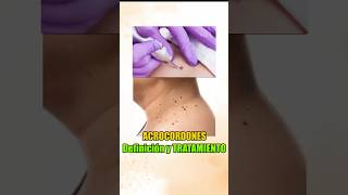 Skin tags (moles) on the neck. Treatment. #dermatology #skintags