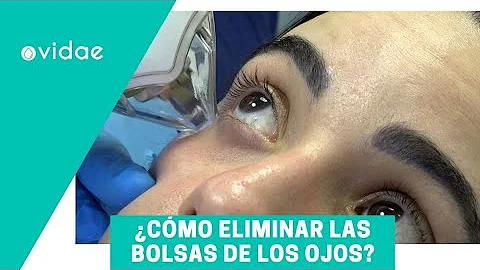 ¿Puede Ultherapy reducir las bolsas de los ojos?