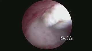 G0 endometrial myoma of uterus, IBS hysteroscope to remove.