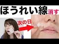 ほうれい線を消す！貼る美容液を試してみた結果！【整形級】