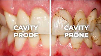 Why You STILL Get Cavities Even If You Brush Daily