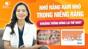 Niềng răng có nên nhổ răng số 4, số 5 - Khoảng nhổ răng được đóng lại như thế nào?