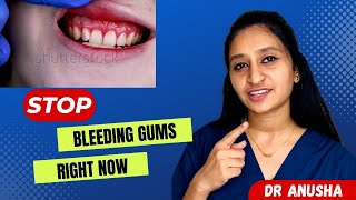 How to Stop Bleeding Gums | All you need to know about Gum Bleeding | Dr Anusha | 32thedentist