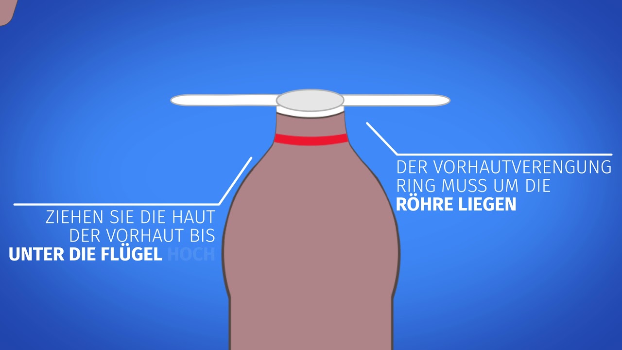 Mann heilung beschneidung Beschneidung beim