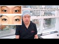 Plastic Surgeon Explains Different Double Eyelid Procedures | Seoul Guide Medical