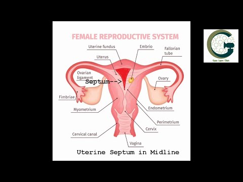 Video: Septate Uterus: Bagaimana Pengaruhnya Terhadap Kehamilan, Rincian Pembedahan