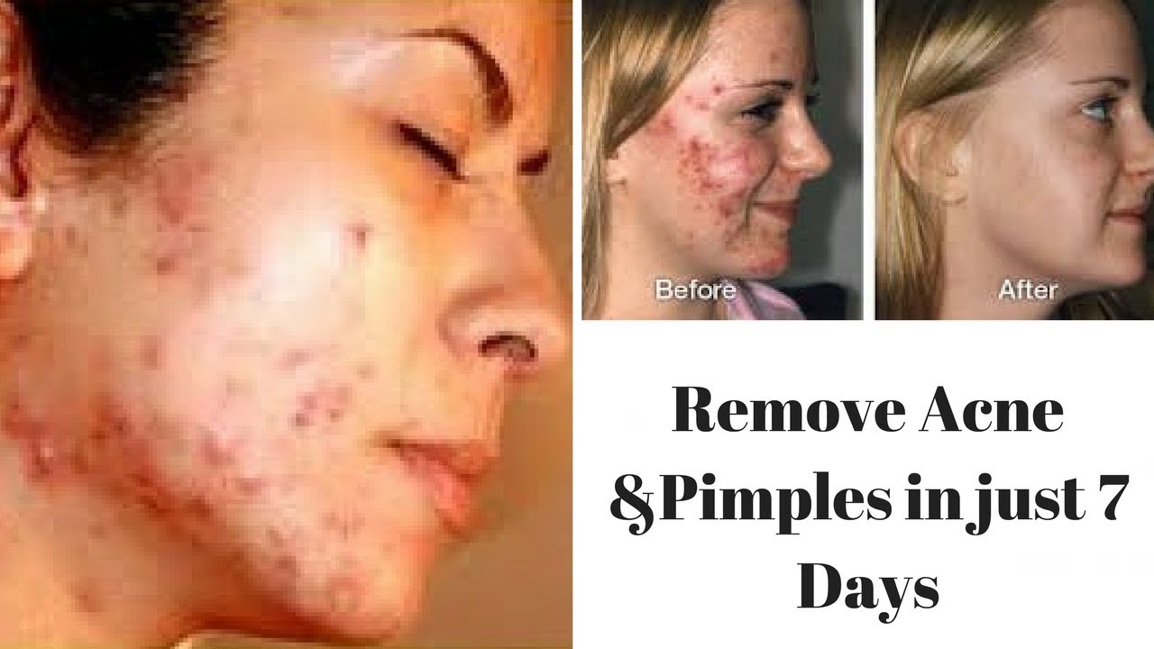 How To Get Rid Of Acne Scars Andpimples In Just 7 Days Best Acne Marks