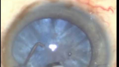 PREVENTION OF ARGENTINEAN FLAG SIGN IN INTUMACENT