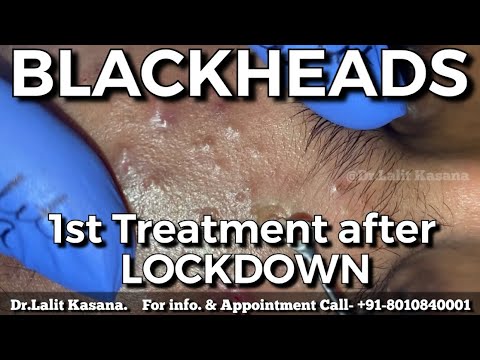 BLACKHEAD REMOVAL by Dr.Lalit Kasana / 1st Treatment after LOCKDOWN