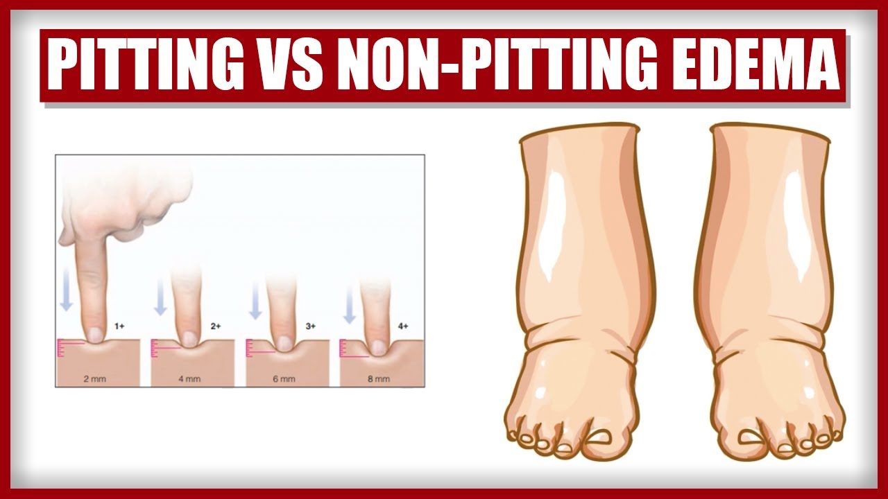 Pitting Edema Non Pitting Edema And What You Can Do About It