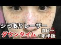 【シミ取りレーザー治療経過】ダウンタイム・金額・痛み・効果/1日目〜1年半後までピコスポットシミそばかす取り放題/日焼け対策・美容内服も全てお話しします！