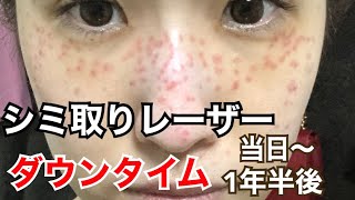 【シミ取りレーザー治療経過】ダウンタイム・金額・痛み・効果/1日目〜1年半後までピコスポットシミそばかす取り放題/日焼け対策・美容内服も全てお話しします!