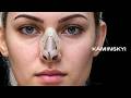 Slide Deviation Rhinoplasty: Correcting Mild Crooked Noses ⭕️ KAMINSKYI