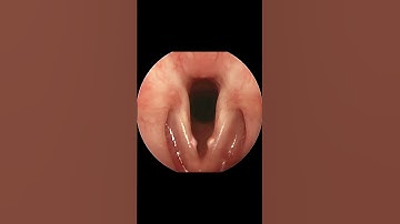 Time Lapse of Vocal Cord Nodule Formation and Resolution