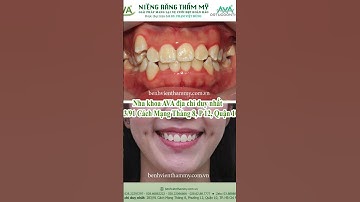 Niềng răng khấp khểnh trước và sau tại Nha khoa AVA  #niengrang #niềngrăngtrongsuốt #niengrangho