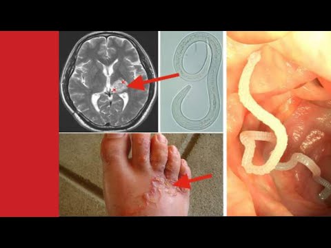 Vidéo: Traitement Des Parasites Dans Le Corps Humain: Remèdes Populaires