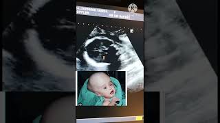 hydrocephalus/ventriculomegaly/bucha ka  sir ma Pani fetus pregnamcy surgery anamolus baby