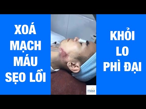 Trị sẹo lồi trên mặt - Xóa mạch máu trên sẹo lồi bằng công nghệ Laser chỉ có tại Maia