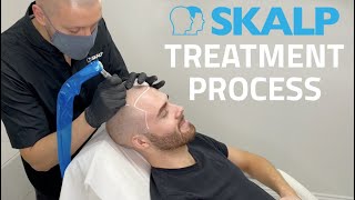 Skalp® Scalp Micropigmentation Treatment Process