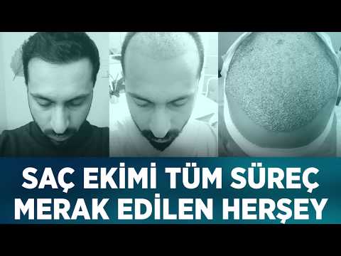 Saç Ekimi Süreci & Merak Edilenler - Hair Transplant Process & Eveything You Need To Know