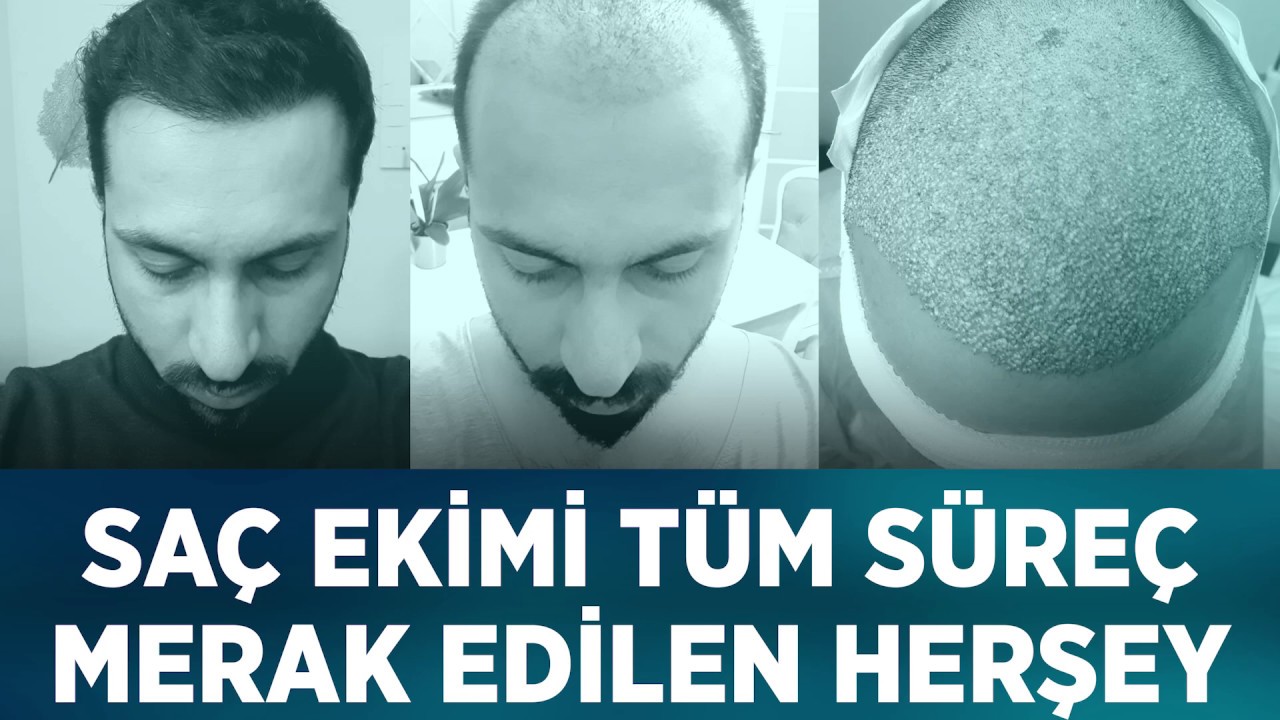 Sac Ekimi Sureci Merak Edilenler Hair Transplant Process Eveything You Need To Know Youtube