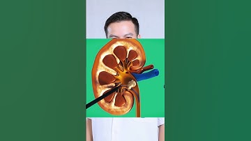 Mô phỏng sỏi thận #Soithan #tansoithan  #bacsitung #pcnl #aroretic #akicare #soinieuquan