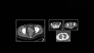 Acute Pulmonary Presentations Part 2 | Free Radiology CME