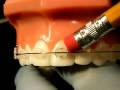 Bracesquestions.com - Braces Problems: Pain, Poking Wire, Sore Teeth, Broken Bracket