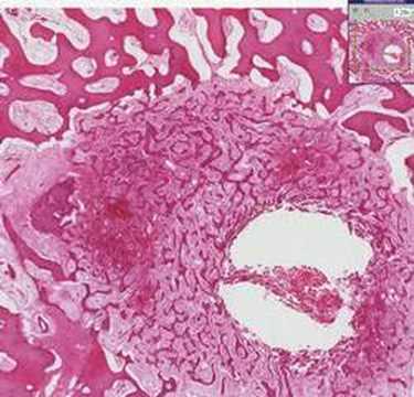 Review Osteoarthritis Histopathology