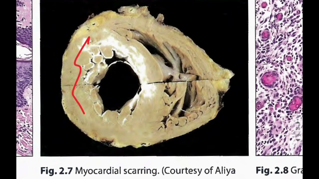 CLS - Pathology - Lecture 5- Tissue repair- part 1