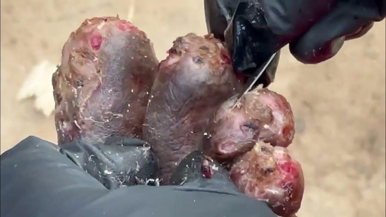 Solomon's right foot jigger dug MANY JIGGERS AND DEAD SKIN removed