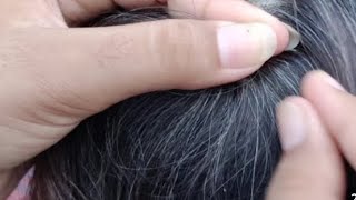 Old Lady Head Lice Removal | Nits Cleaning Process | Satisfying Hair Care