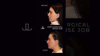 ? Non Surgical Nose Job or Rhinoplasty | NYC Rhinoplasty Expert nonsurgicalrhinoplasty