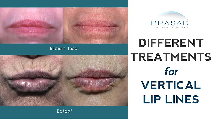 How Vertical Lip Lines/ Lip Wrinkles can be Treated With Minimal to No Downtime
