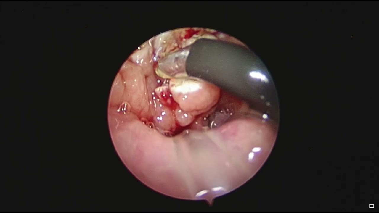 Adenoidectomy, Evac 70 wand coablation, 70 degree telescope with music