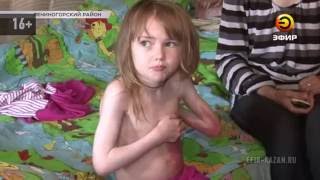 Девочка из деревни Лениногорского района страдает от редкой генетической болезни