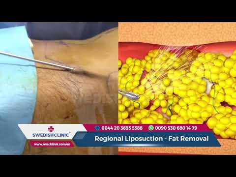 Liposuction Surgery 2019