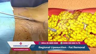 Liposuction Surgery 2019
