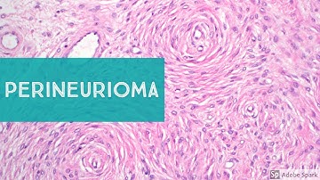 Perineurioma...Explained by a Soft Tissue Pathologist
